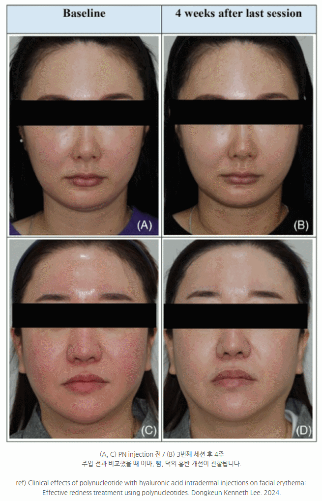 광교리쥬란 나에게는 맞지 않을 수 있어요 사진