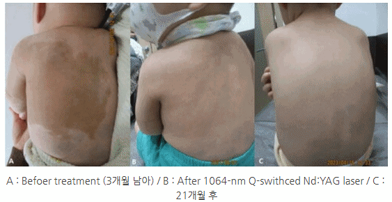 수원 밀크커피반점 궁금증 3가지 피부과 전문의가 모두 알려드립니다 사진