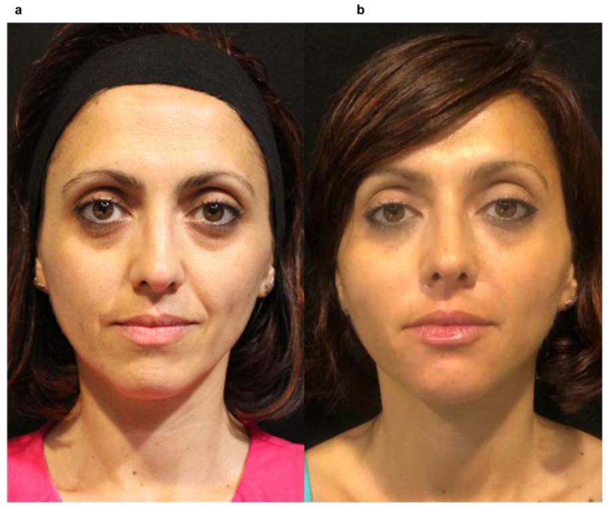 용인 레디어스 필러랑 뭐가 다른 걸까? 사진