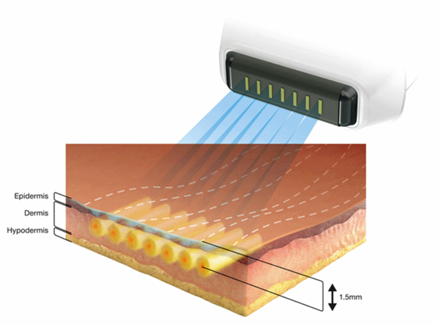수지구피부과 소프웨이브 써마지 울쎄라 중 고민된다면 이렇게 해보세요 사진