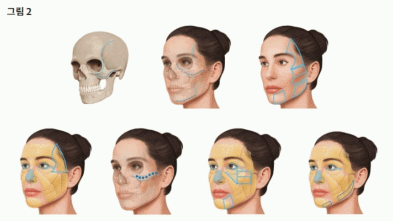 광교중앙역 피부과에서 말하는 레디어스, "단순히 볼륨만 채우지 않습니다" 사진