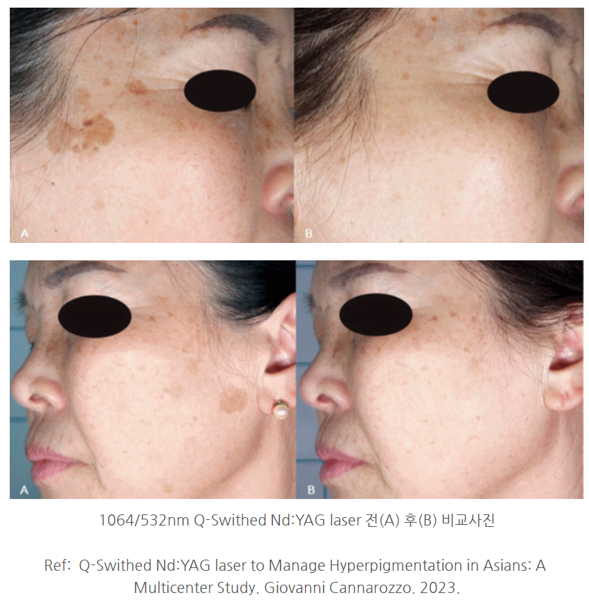 우만동피부과 잡티 제거 이것 주의하고 받으셔야 합니다 사진