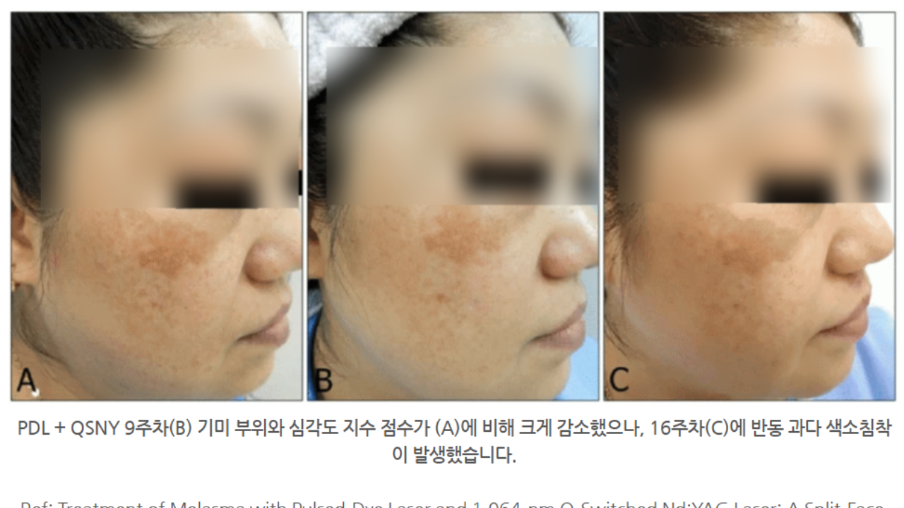 수원피코토닝, 여러 번 했는데도 그대로인 이유가 있을까요 사진