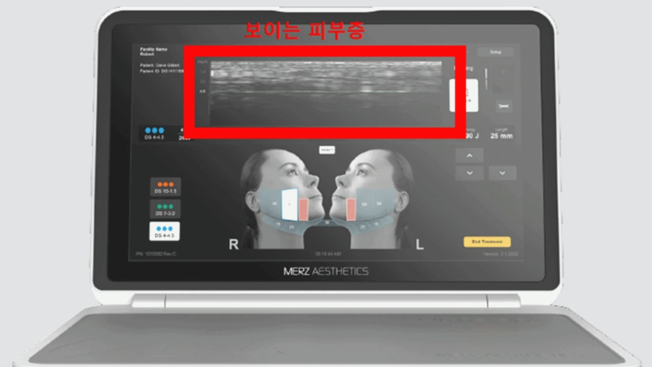 울쎄라(Ulthera)란 무엇인가? — 의학 논문으로 알아보는 작용 원리와 임상 효과 사진