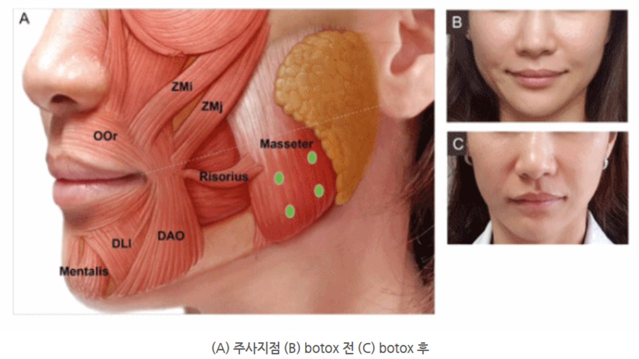 광교보톡스 몇 회까지 받아야 하는 걸까?