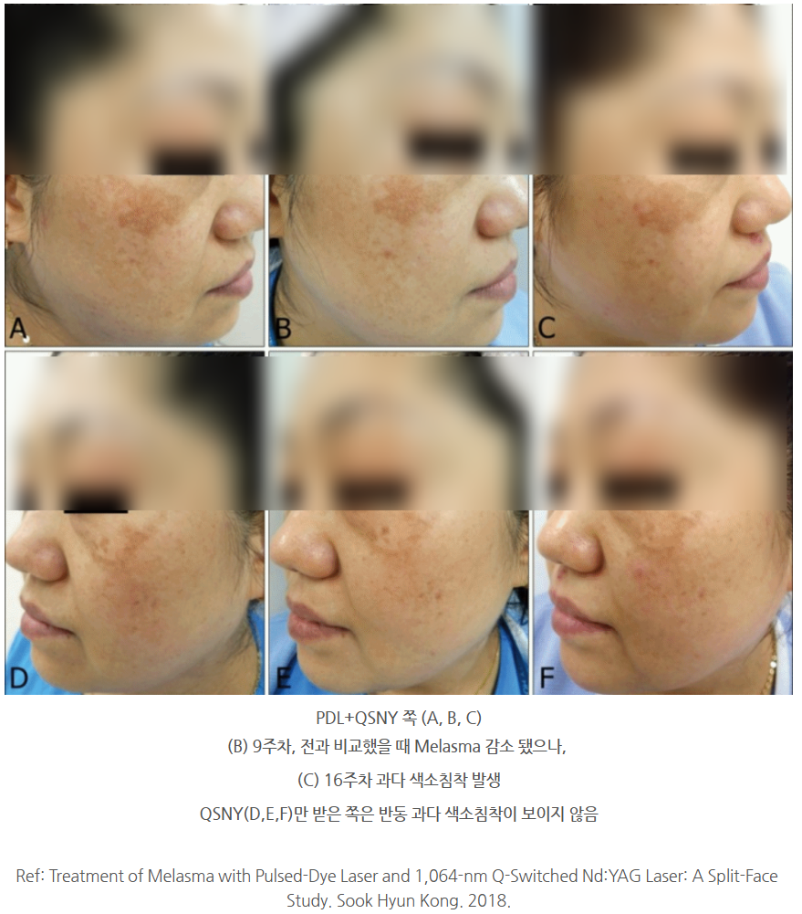 광교잡티제거, 했는데도 다시 올라오는 이유가 있을까요?